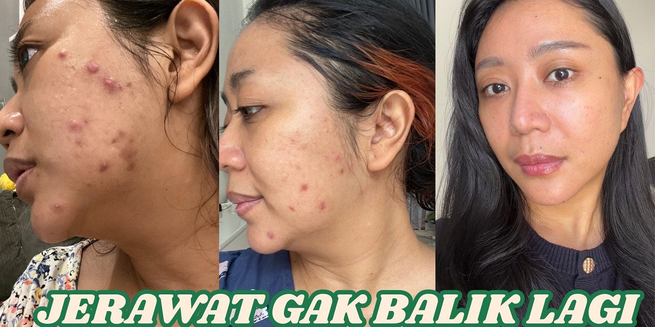 Cara Mengobati Cystic Acne Secara Bertahap Dan Juga Rutin