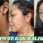 Cara Mengobati Cystic Acne Secara Bertahap Dan Juga Rutin