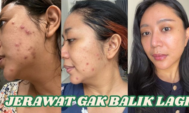 Cara Mengobati Cystic Acne Secara Bertahap Dan Juga Rutin