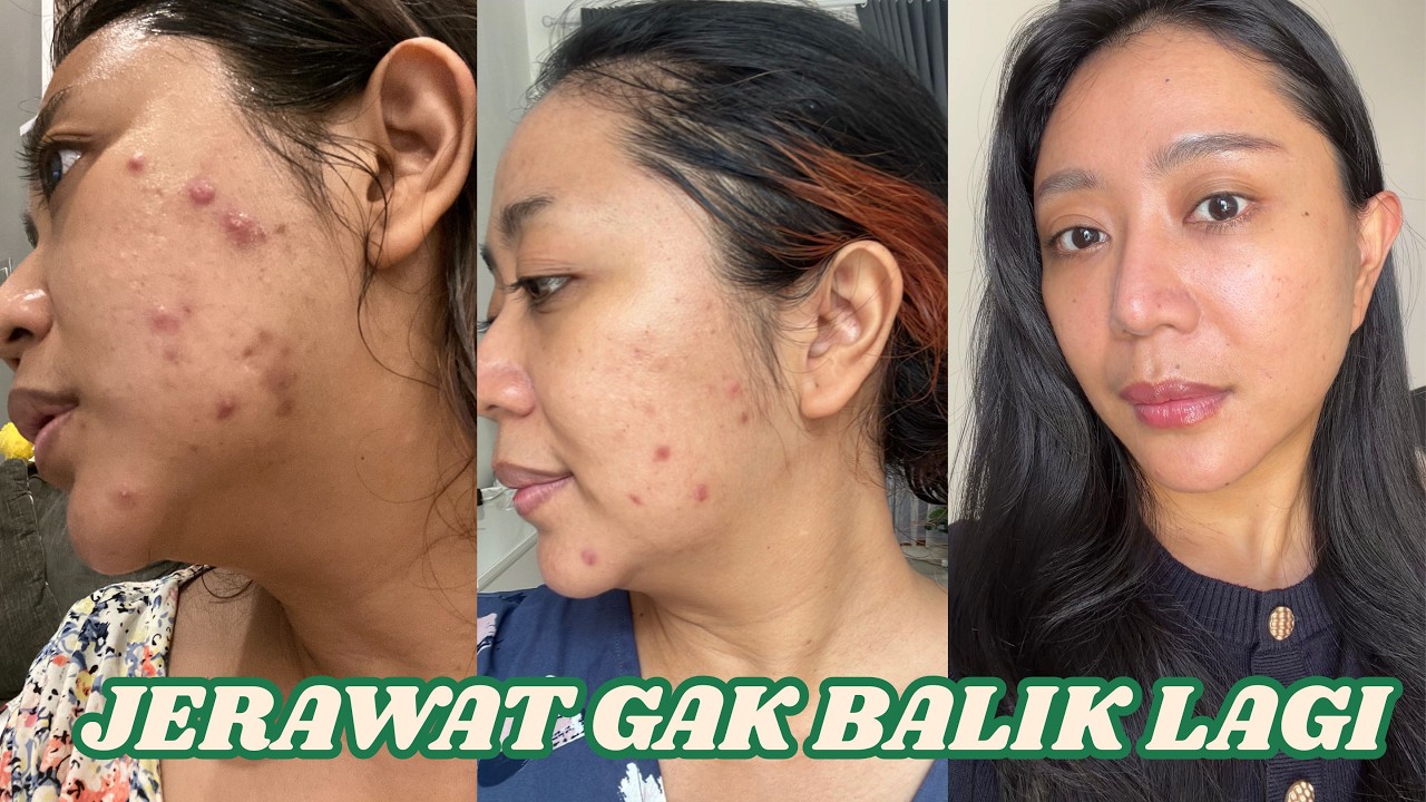 Cara Mengobati Cystic Acne